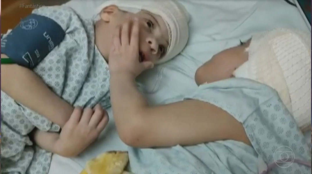 Τα σιαμαία που διαχωρίστηκαν στη Βραζιλία