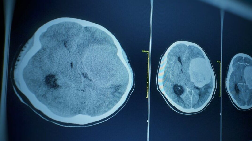  πέθανε από ναιγλερίαση που προκλήθηκε από μια σπάνια αμοιβάδα