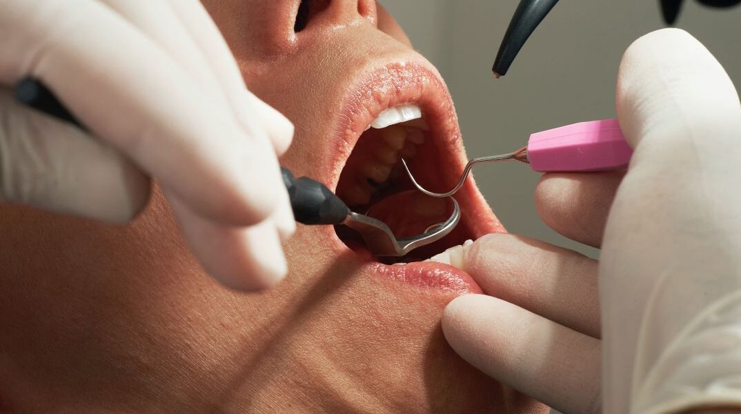ΗΠΑ: Γυναίκα μηνύει οδοντίατρο για 4 απονευρώσεις, 8 θήκες και 20 σφραγίσματα σε ένα ραντεβού