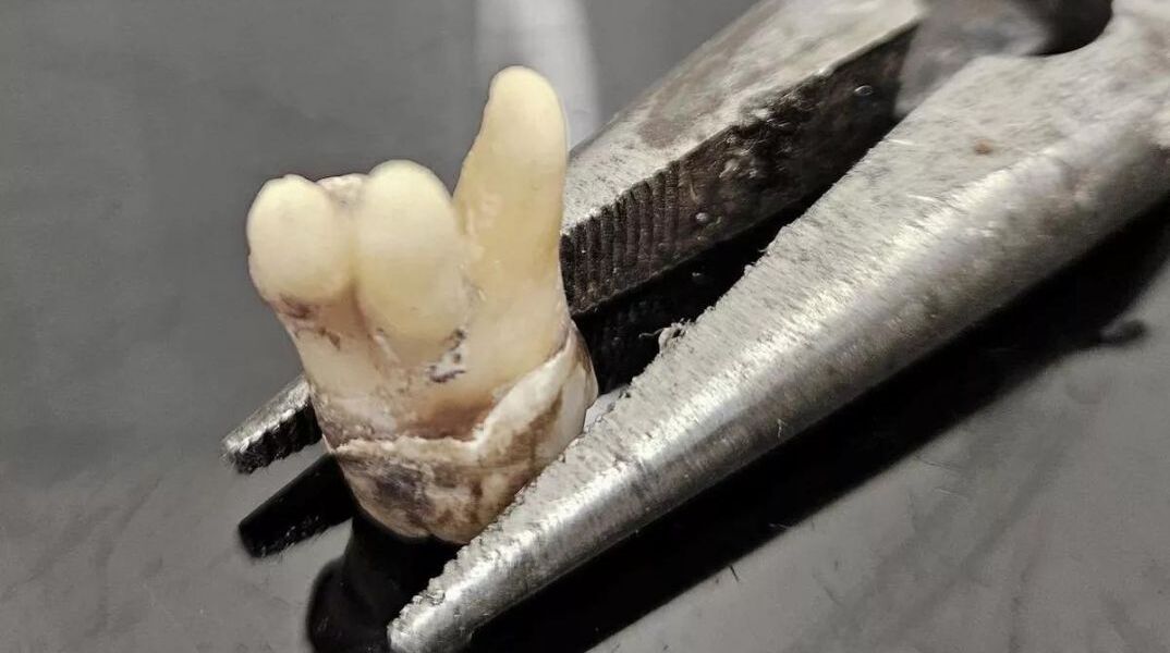 Βρετανία: Πολίτες αναγκάζονται να βγάζουν μόνοι τους τα δόντια τους