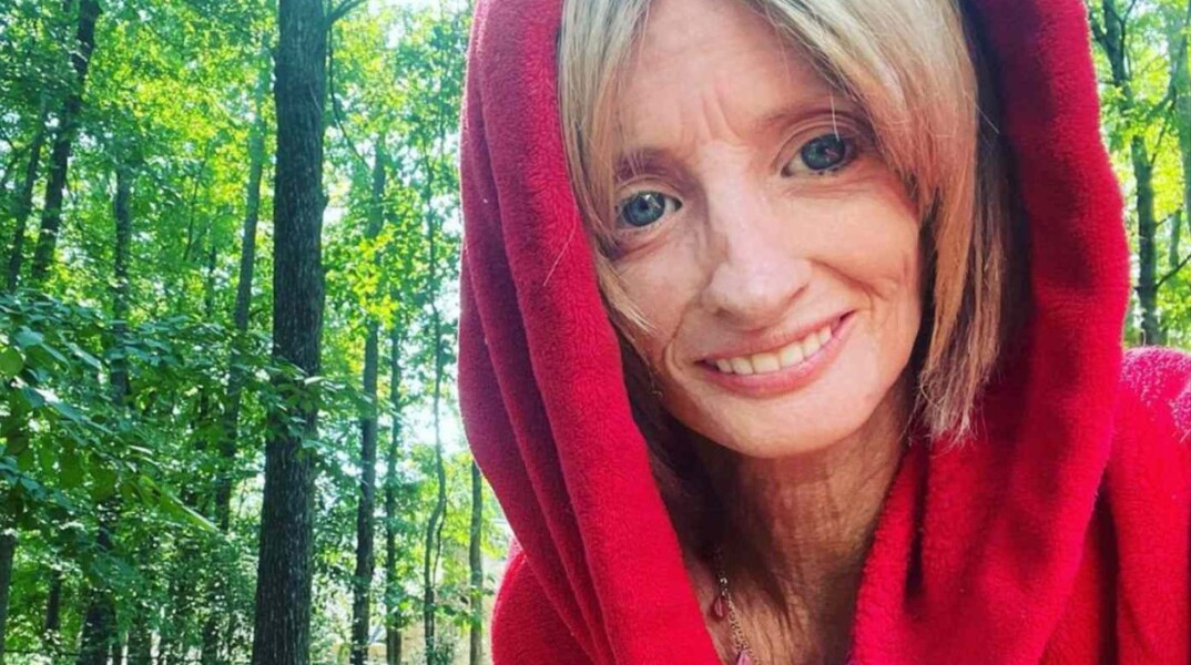 Γυναίκα αποκαλύπτει τη ζωή της με τη σπάνια πάθηση «Benjamin Button»