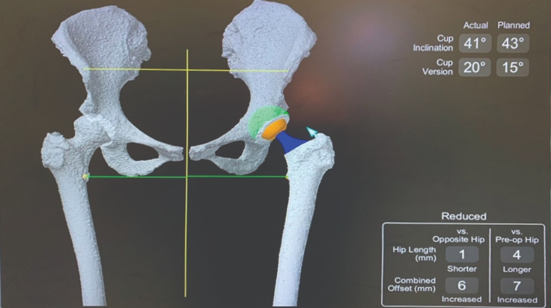 Νεότερες εξελίξεις στην αρθροπλαστική ισχίου