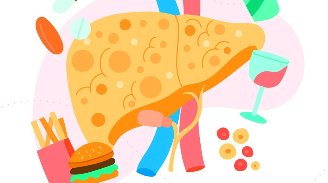 Λιπώδης διήθηση ήπατος | Μέθοδοι πρόληψης και θεραπεία