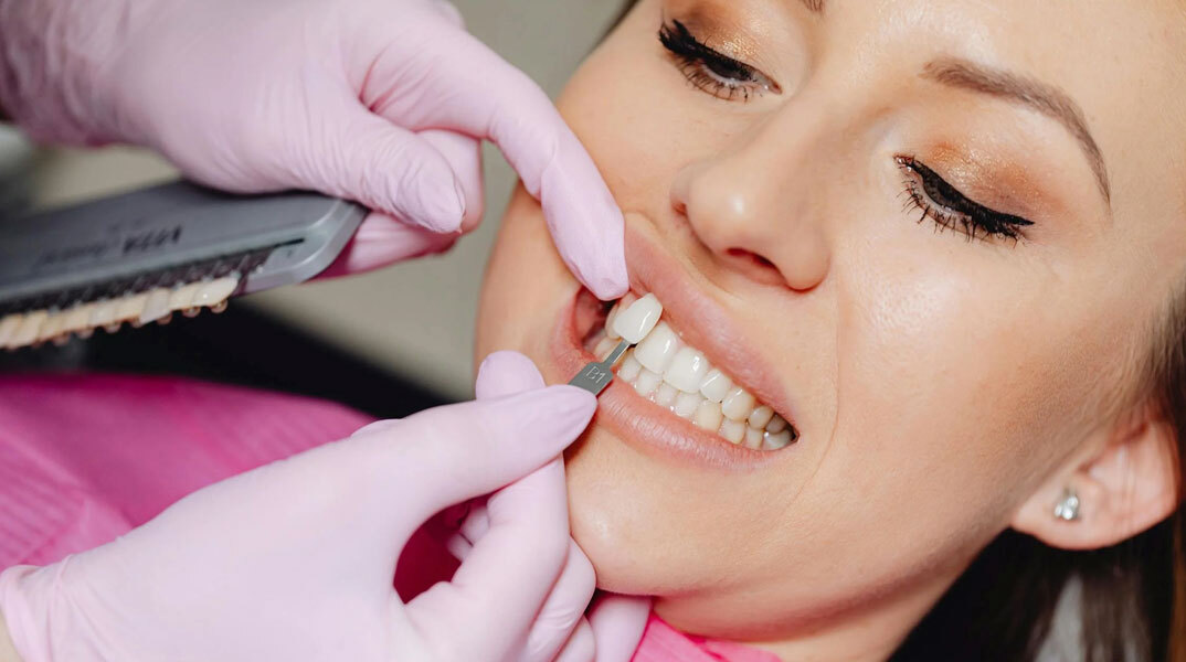 Όψεις πορσελάνης