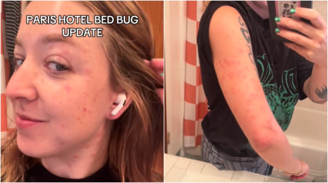 Κοριοί στο Παρίσι: Η σοκαριστική εμπειρία τουρίστριας - Τσιμπήματα σε όλο της το σώμα 