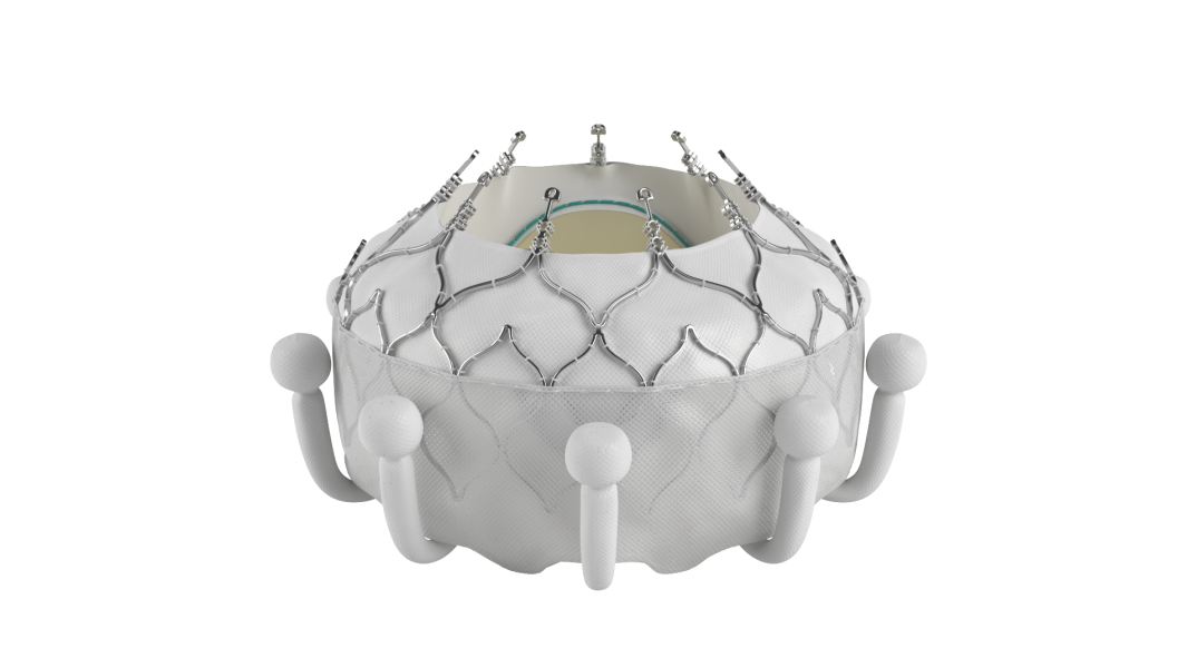 ΥΓΕΙΑ: Οι πρώτες στην Ελλάδα διαδερμικές εμφυτεύσεις ορθοτοπικής τριγλώχινας βαλβίδας 