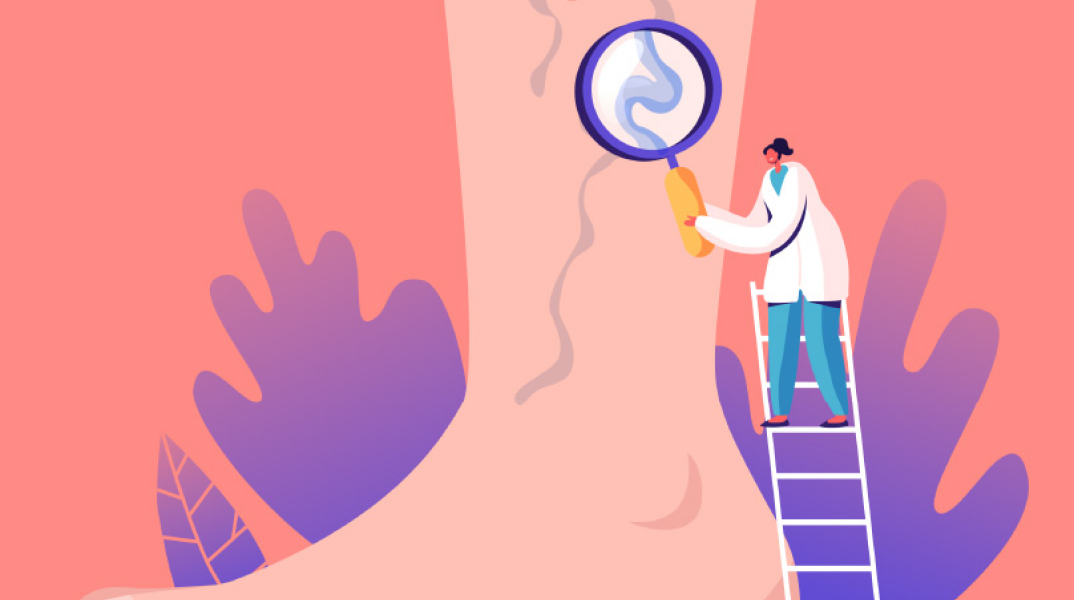 Kιρσοί των κάτω άκρων: 18 ερωτήσεις και απαντήσεις 