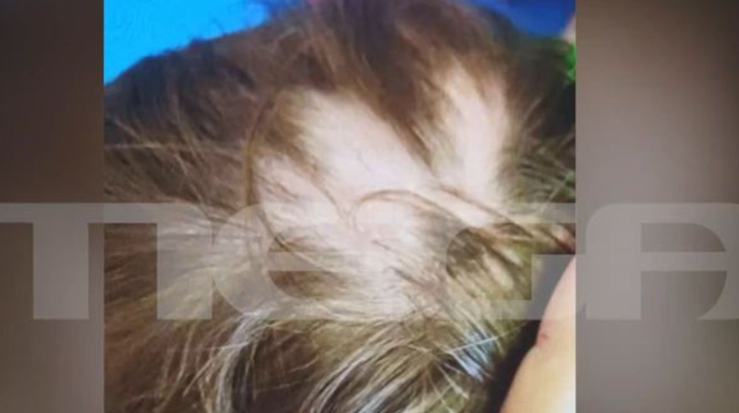 Αυλώνας: Συγκρούονται οι εκδοχές για το 2χρονο παιδί που έλειπαν τούφες από τα μαλλιά του