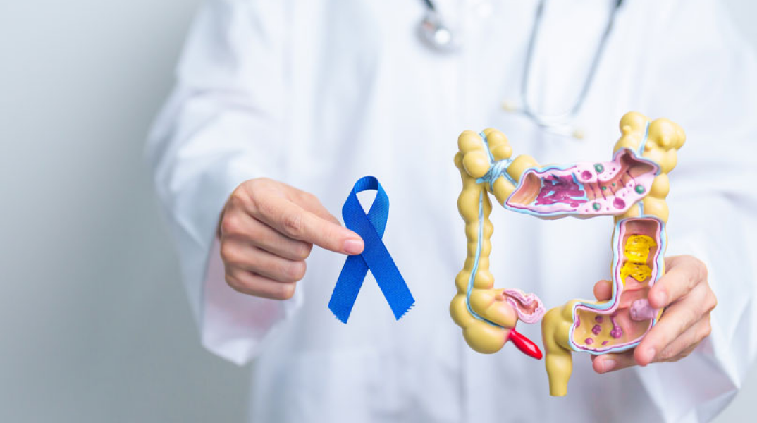 καρκίνος παχέος εντέρου