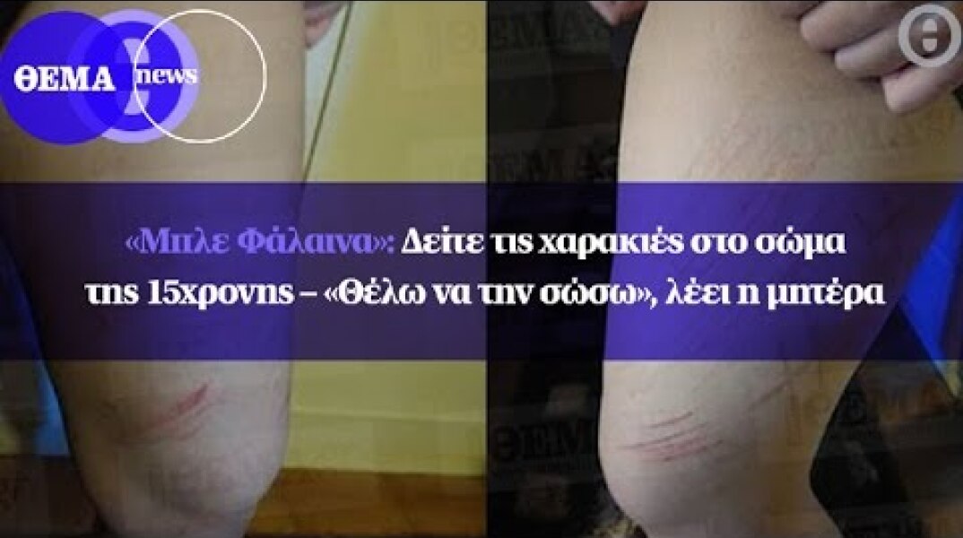 «Μπλε Φάλαινα»: Δείτε τις χαρακιές στο σώμα της 15χρονης – «Θέλω να την σώσω», λέει η μητέρα