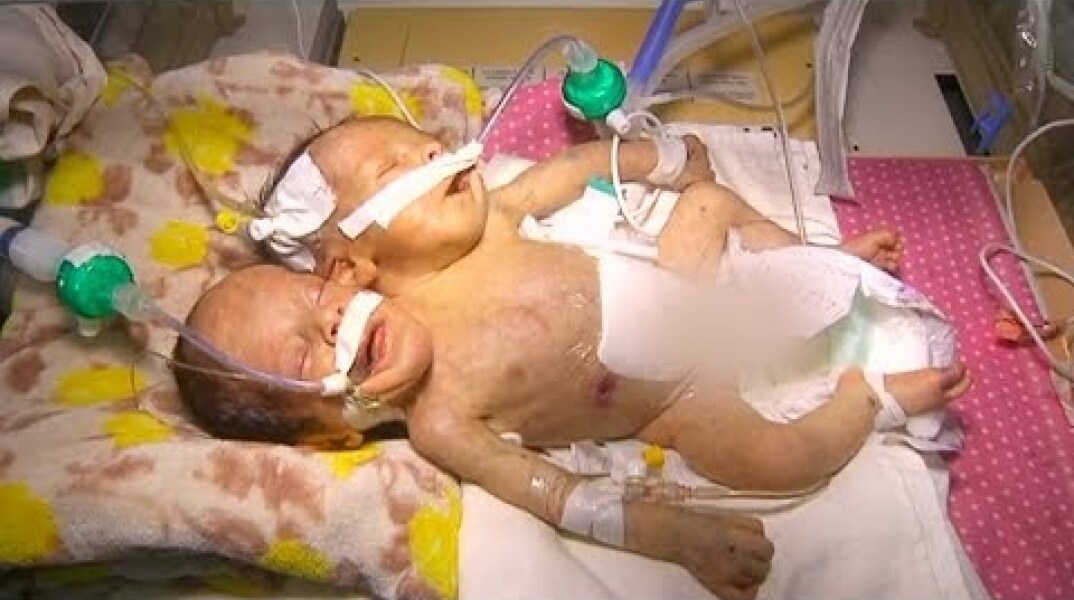 Conjoined twins in Yemen need international support to survive