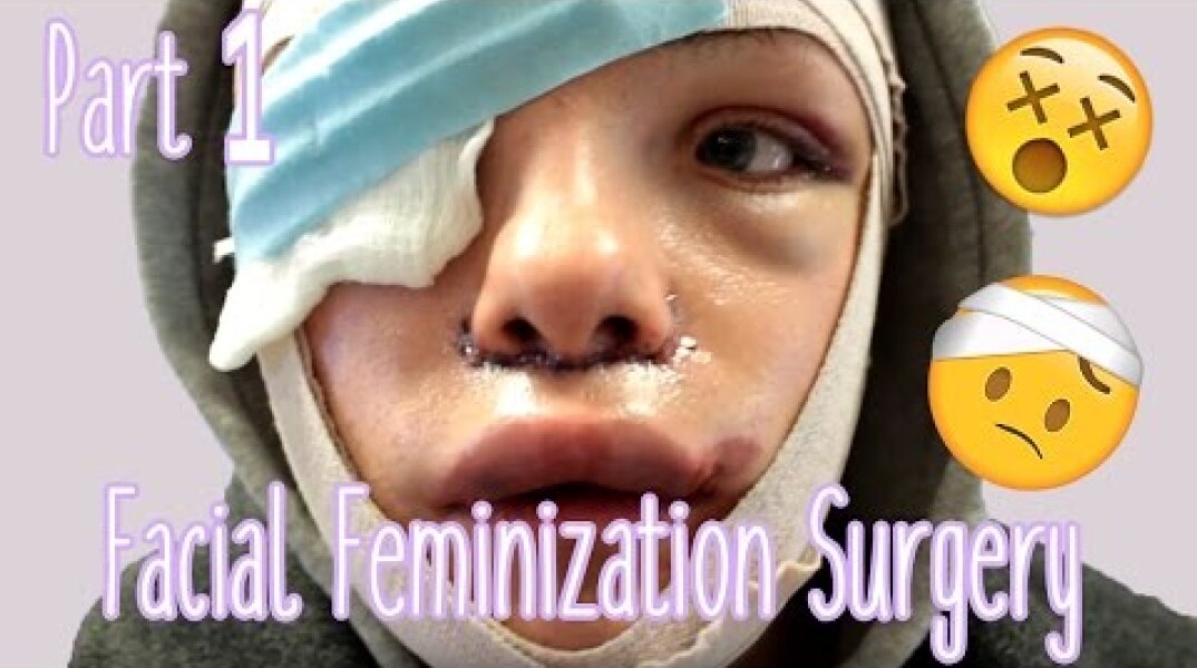 Facial Feminization Surgery - Day 1 & 2 (GRAPHIC) | Stef Sanjati