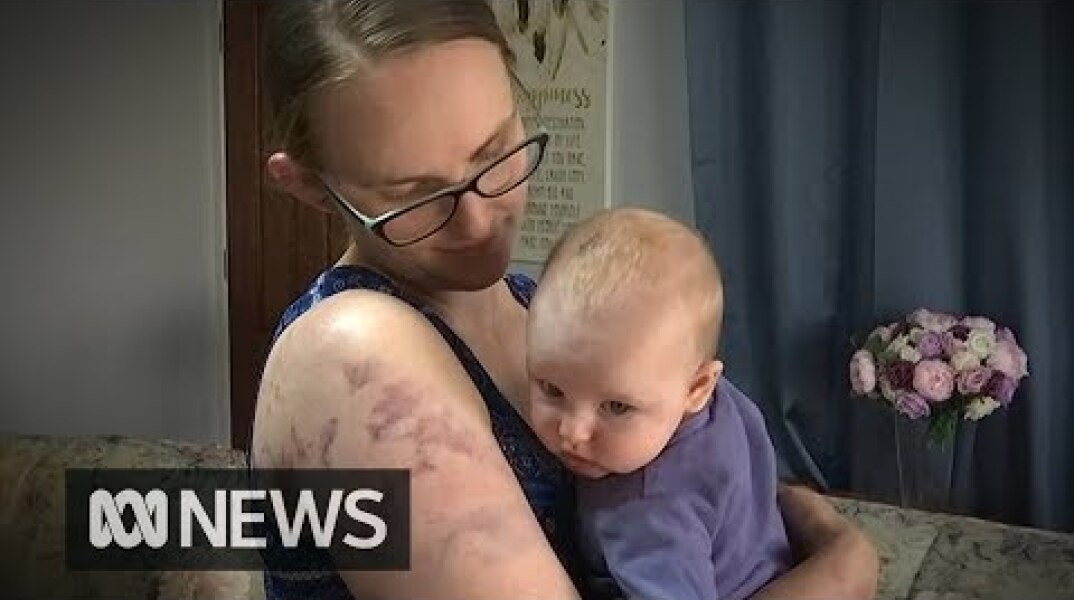 Mum risked her life to protect baby from giant hail | ABC News