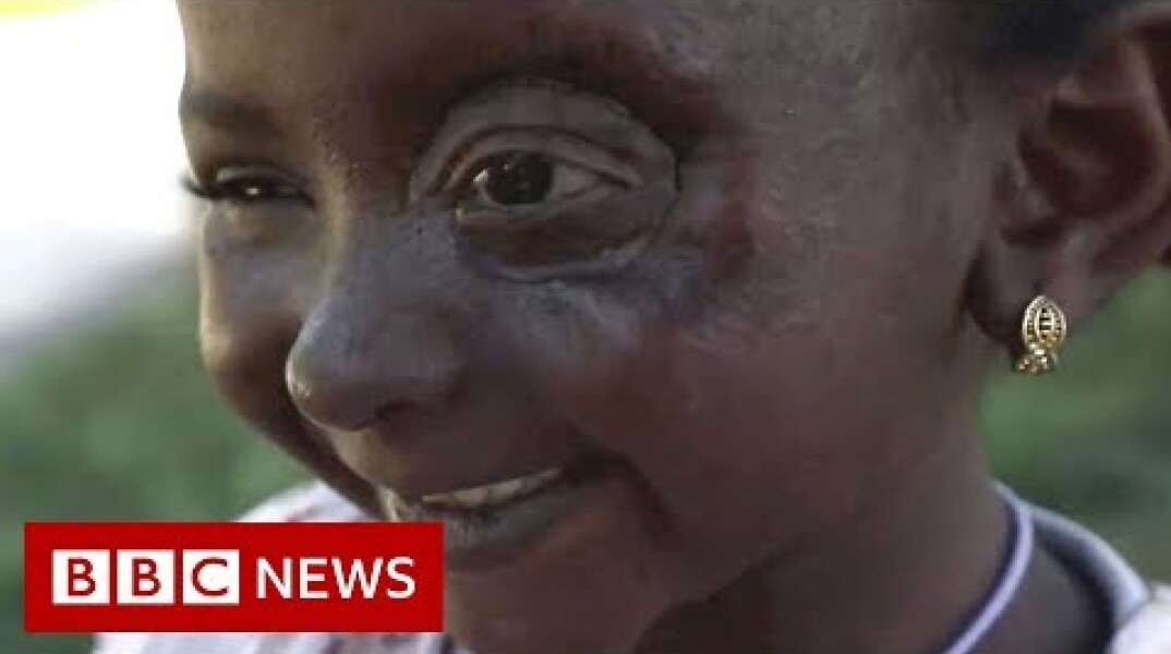 Yemen conflict: Six-year-old Yusra’s new eye - BBC News