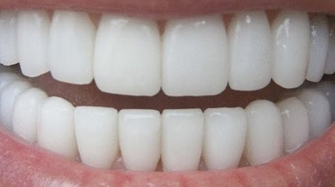 How To Have Natural White Teeth in 3 minutes ( Works 100% )