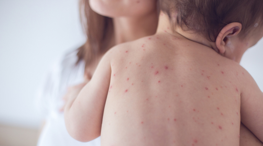 measles-preview.jpg