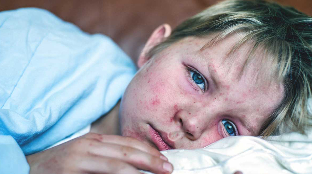 child_measles-1296x728-header.jpg