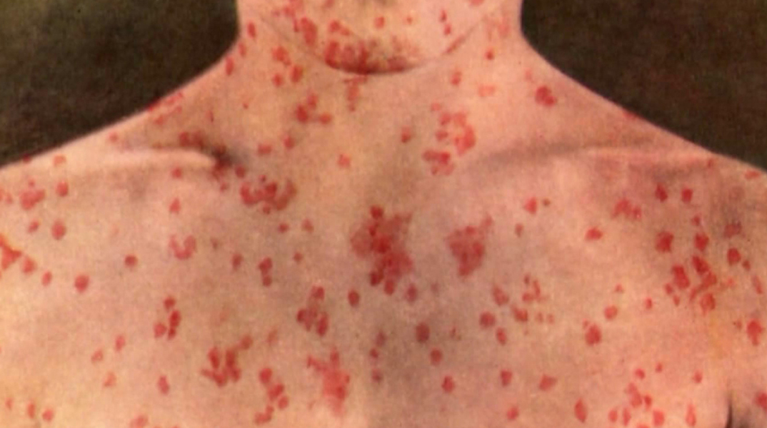 measles_1.jpg
