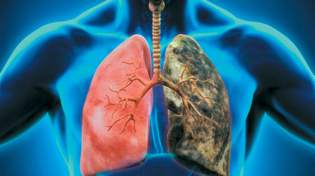 Καρκίνος του πνεύμονα