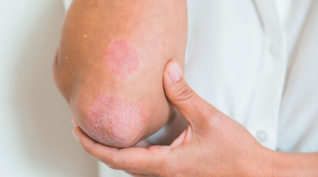 psoriasis-530693162-57810efc3df78c1e1ff59599.jpg