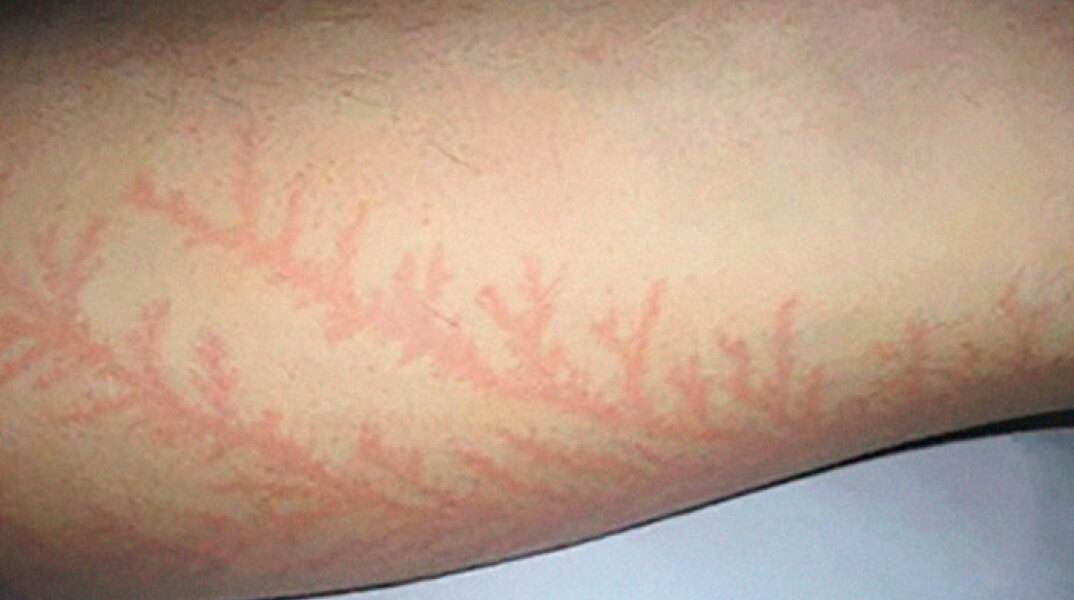 scars-after-surviving-lightning-strike-lichtenberg-figures-photos-3-5b6d321fb308f_700.jpg
