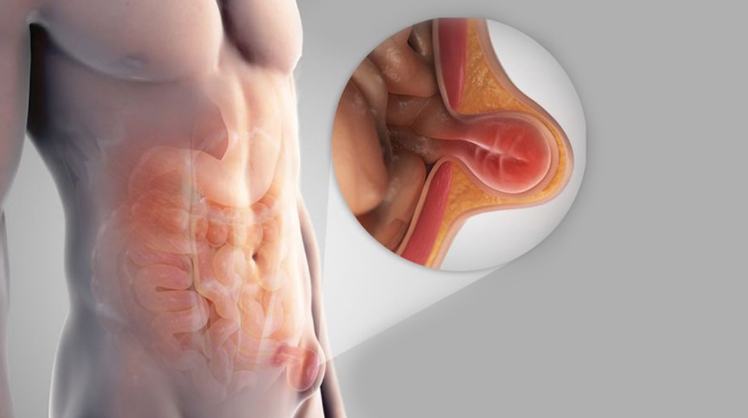 Βουβωνοκήλη