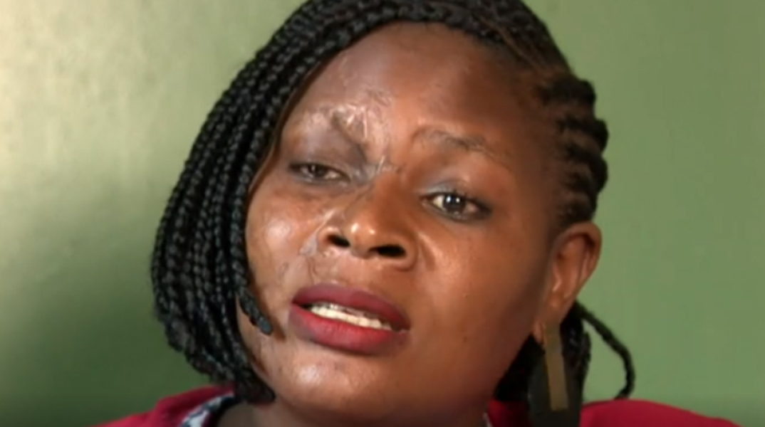 Γυναίκες θύματα επιθέσεων με οξύ