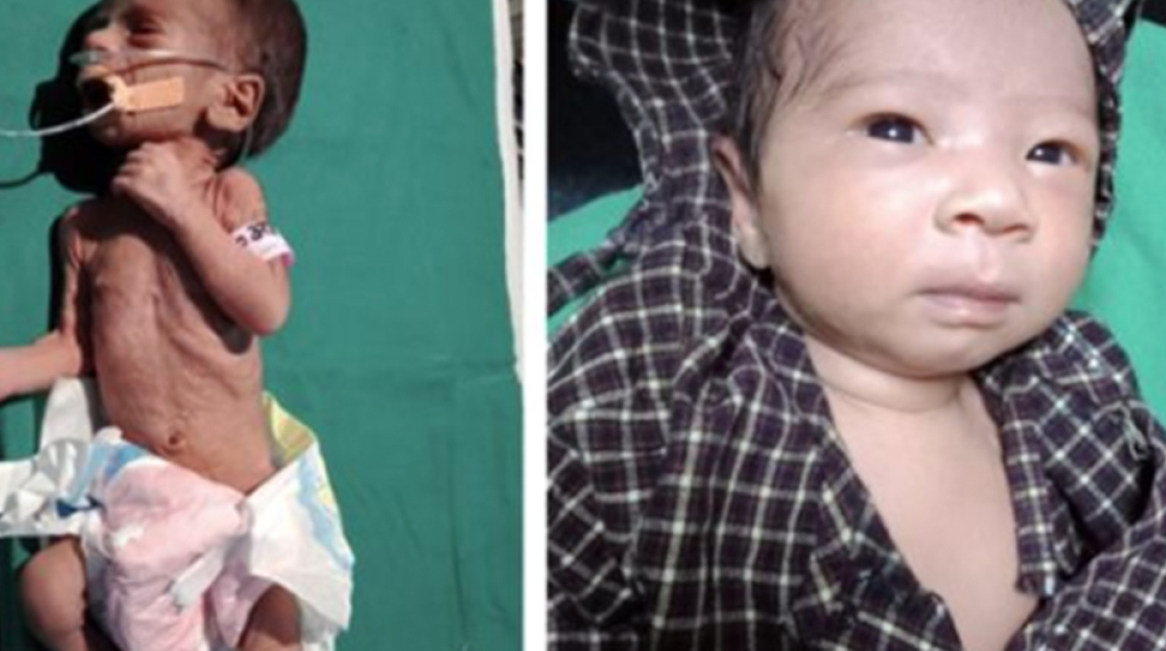Το μωρό που βρέθηκε θαμμένο ζωντανό στην Ινδία