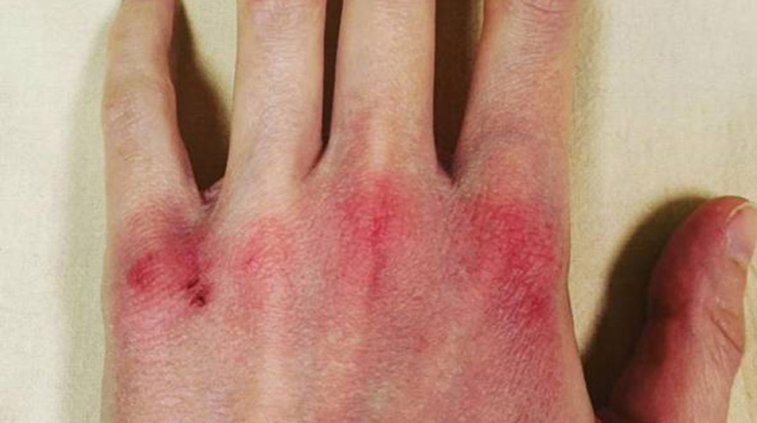 Κορωνοϊός - Φλωρεντία - νοσηλεύτρια