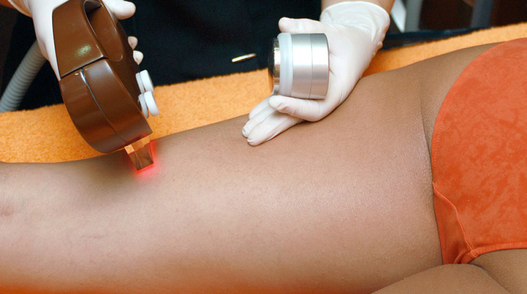 Αποτρίχωση με λέιζερ