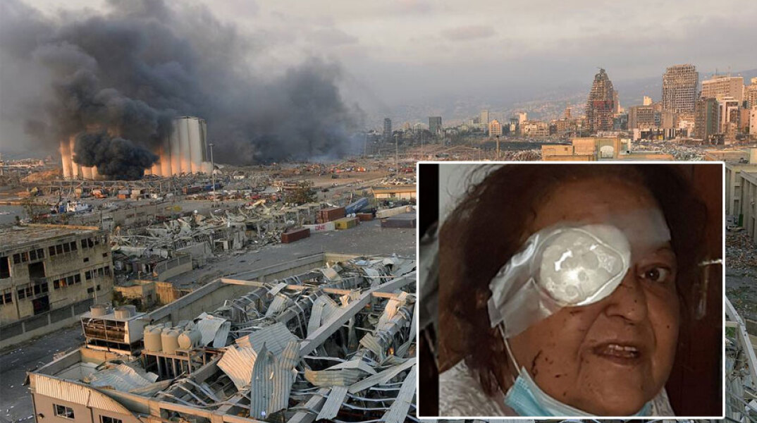 Έκρηξη στη Βηρυτό: Η Άννα Αρμάου, η Ελληνίδα που ζει μόνιμα στον Λίβανο και έχασε το μάτι της