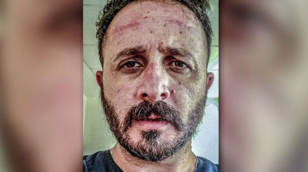 Κορωνοϊός: Ο ακτινολόγος στο ΠΑΓΝΗ Ευθύμης Φασουλάκης δείχνει τα σημάδια στο πρόσωπό του από την πολύωρη χρήση της μάσκας