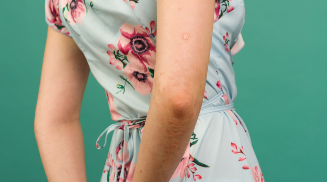 Ψωρίαση: Ποιες τροφές πρέπει να αποφεύγετε