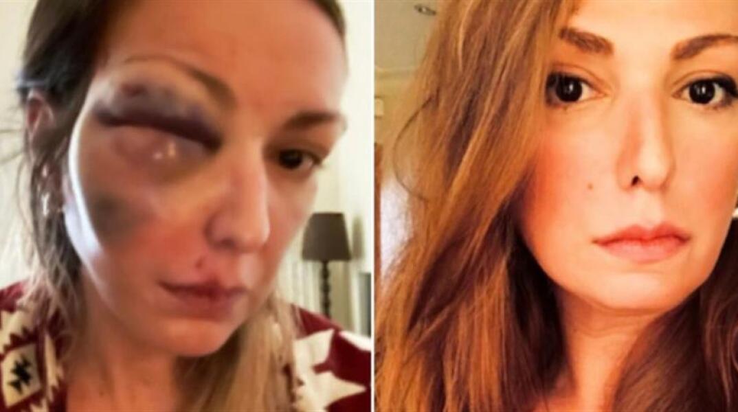 Μυστήριο με την Food Blogger που κατήγγειλε ότι έπεσε θύμα ξυλοδαρμού 