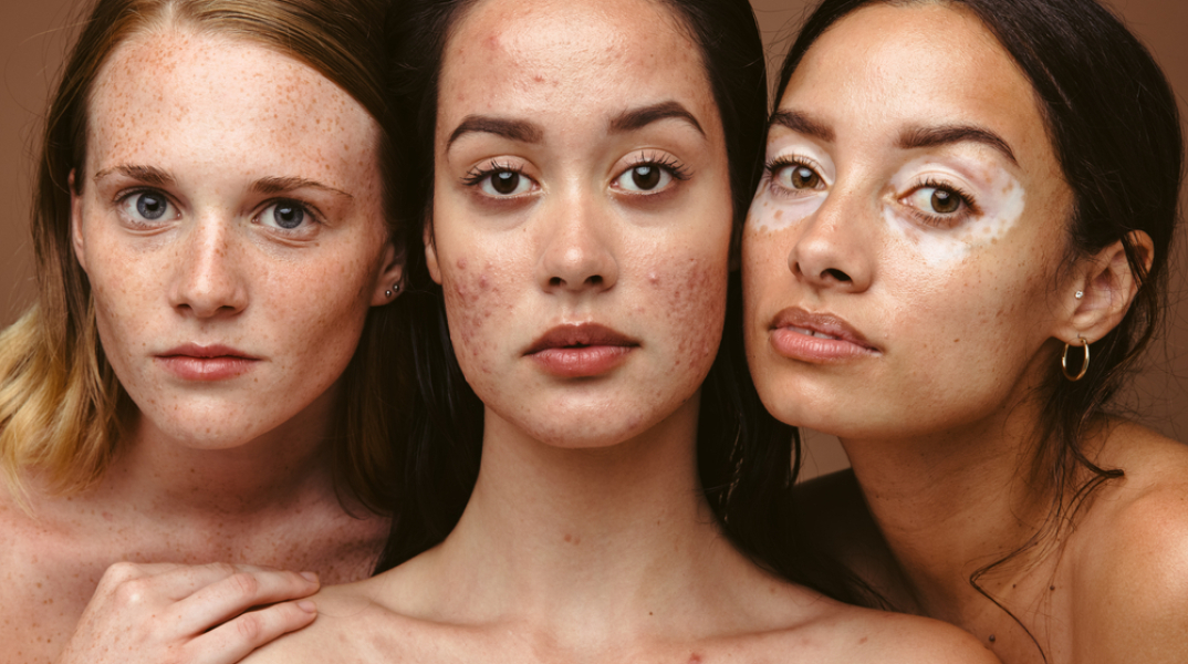 Ποιες παθήσεις αποχρωματίζουν την επιδερμίδα;