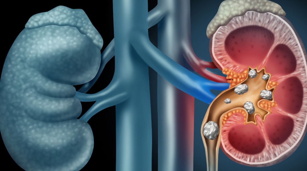 Πώς αντιμετωπίζονται σήμερα οι πέτρες στα νεφρά; 