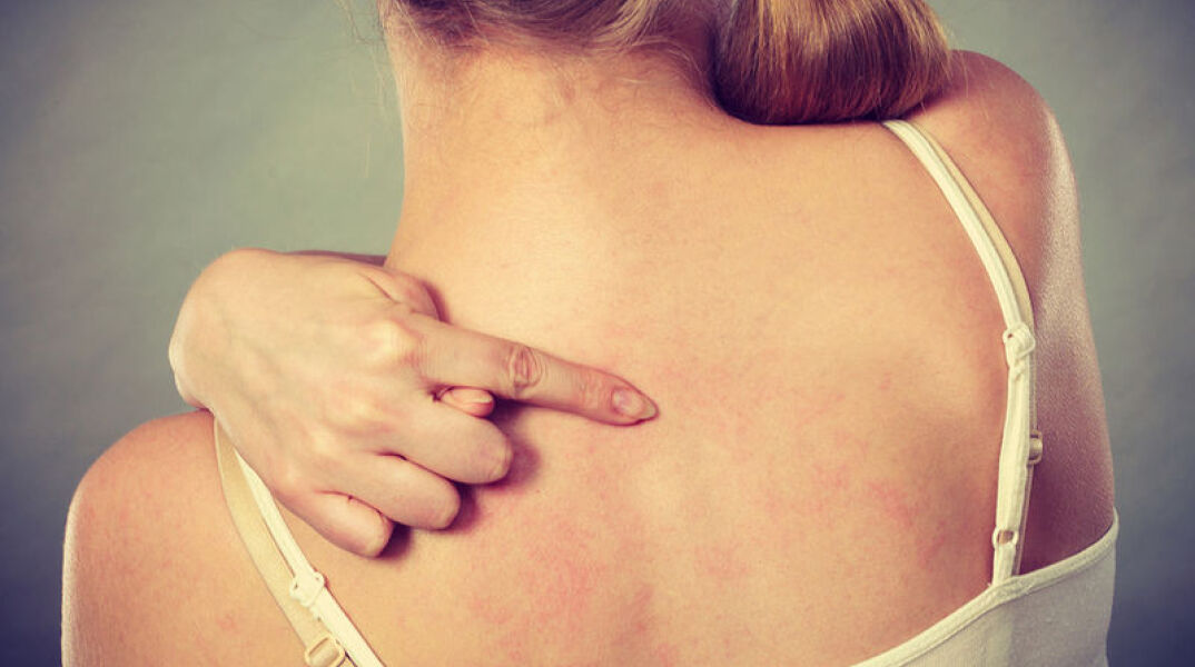 Δερματικό εξάνθημα