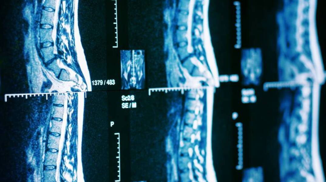 Εφαρμογή της ρομποτικής χειρουργικής της σπονδυλικής στήλης