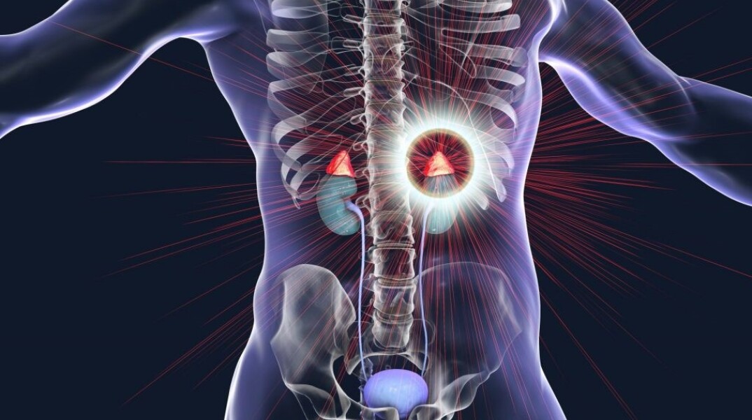 Καρκίνος του φλοιού των επινεφριδίων: Τι πρέπει να γνωρίζουμε