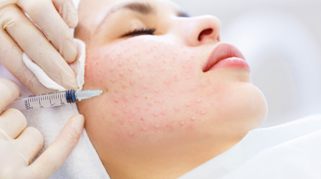 Προσφέρει όσα υπόσχεται η μεσοθεραπεία;