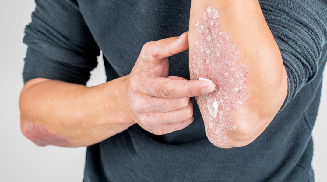 Πού οφείλεται η έξαρση των συμπτωμάτων της ψωρίασης τον χειμώνα;