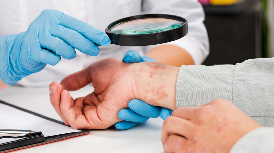 Πώς διαφέρει η θεραπεία της ψωρίασης ανάλογα με το φύλο;