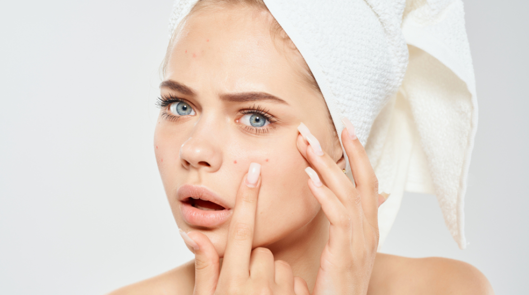 Μπορούν τα προβιοτικά να θεραπεύσουν την ακμή;