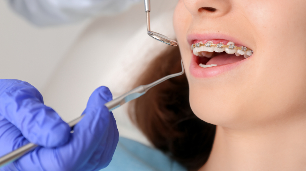 Kακή σύγκλειση των δοντιών: Πώς επηρεάζει τη στοματική υγεία