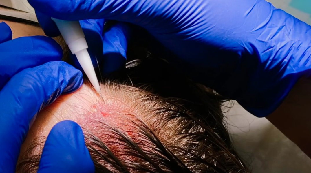 μεταμόσχευση μαλλιών, γυναικεία τριχόπτωση