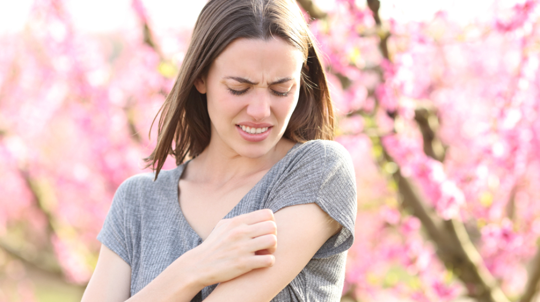 Γιατί μας προκαλεί σπυράκια ο ανοιξιάτικος ήλιος;