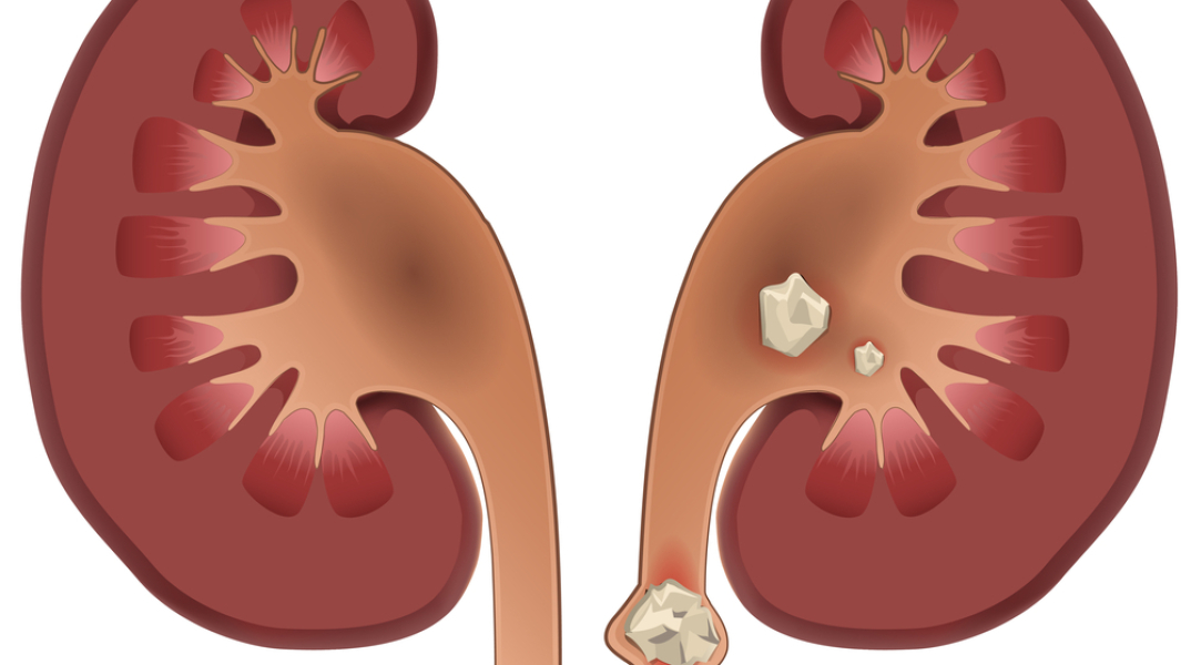 Αφαίρεση της πέτρας στα νεφρά με νέα ελάχιστα επεμβατική θεραπεία 