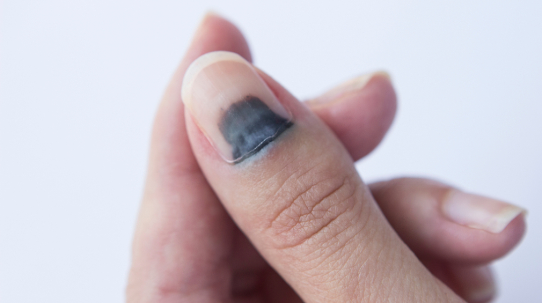 Μελανιά στο νύχι: Γιατί χρειάζεται άμεση ιατρική φροντίδα 