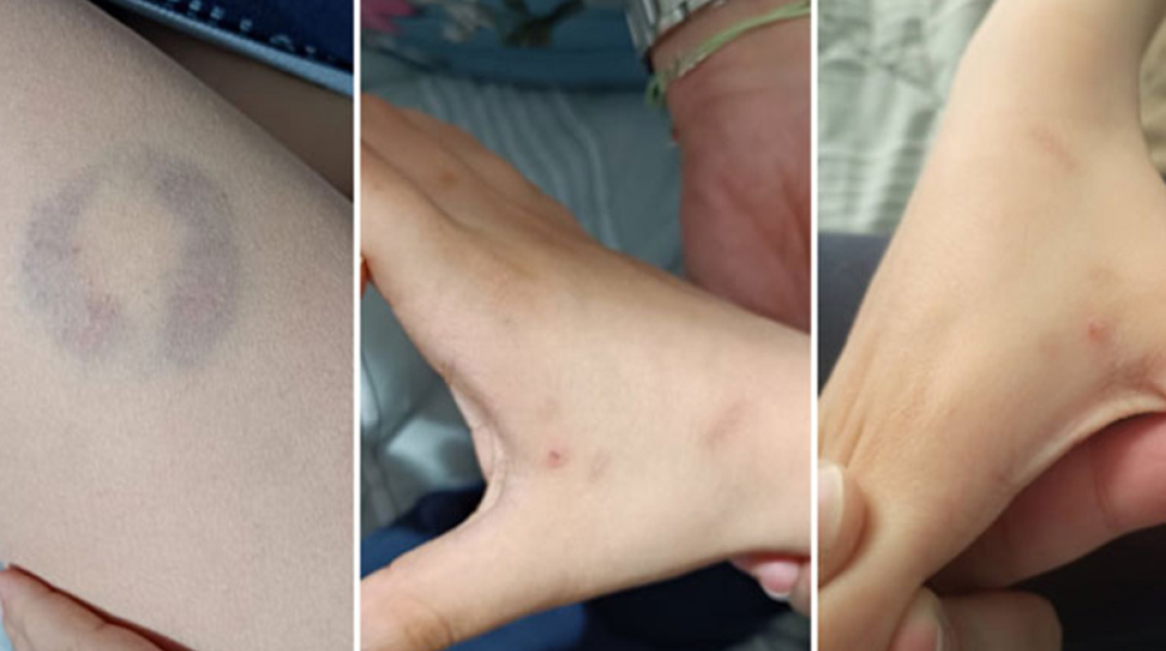 Άρτα: Διευθύντρια σχολείου δάγκωσε παιδί με αυτισμό