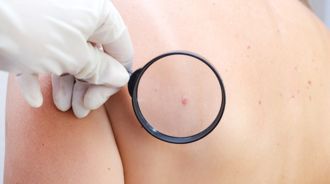 Μελάνωμα: Νεότερα δεδομένα δείχνουν αύξηση στους νέους 